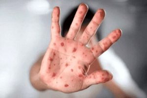 راه‌های انتقال آبله میمونی و اقدامات لازم برای پیشگیری از آن
