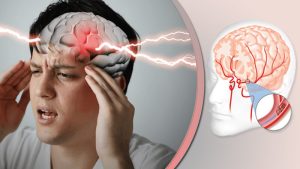 جدیدترین دستورالعمل‌ها برای پیشگیری از سکته مغزی: راهکارهایی ساده اما حیاتی
