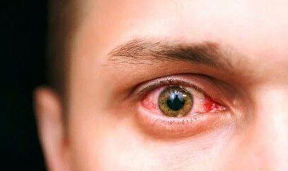 سرطان شبکیه چشم؛ خطری پنهان که ممکن است به تخلیه چشم منجر شود! سرطان شبکیه چشم؛ خطری پنهان که ممکن است به تخلیه چشم منجر شود!