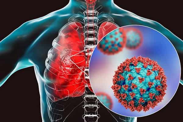 شیوع ویروس‌های تنفسی در ایران: آیا آنفلوآنزا دوباره اوج گرفته است؟