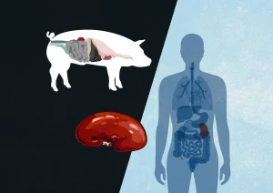 پزشکان چینی تاریخ‌ساز شدند: موفقیت‌آمیزترین پیوند کبد خوک به انسان، دریچه‌ای نو به سوی درمان