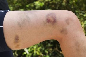 کبودی بی‌دلیل بدن: هشداری که نباید نادیده گرفت